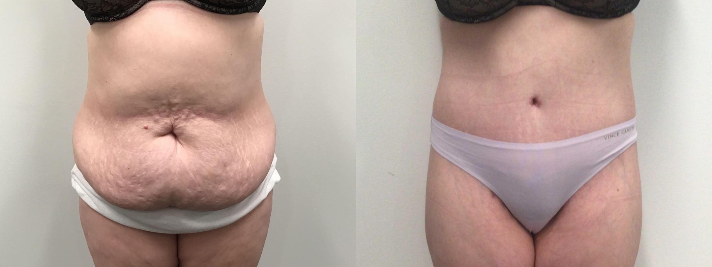 Weight loss and body contouring red light therapy